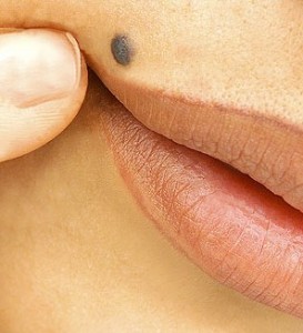 How Do Skin Tags Form